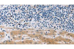 Immunohistochemistry of paraffin-embedded Human liver cancer using MUC20 Polyclonal Antibody at dilution of 1:40 (MUC20 anticorps)
