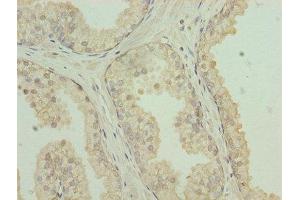 Immunohistochemistry of paraffin-embedded human prostate cancer using ABIN7146065 at dilution of 1:100 (CLEC3A anticorps  (AA 23-197))