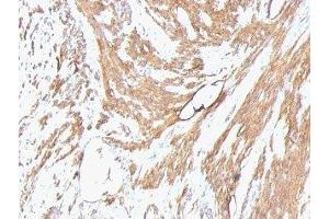 Formalin-fixed, paraffin-embedded human leiomyosarcoma stained with pan Muscle Actin antibody (Pan Muscle Actin anticorps)