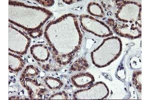 Immunohistochemical staining of paraffin-embedded Carcinoma of Human thyroid tissue using anti-ALG2 mouse monoclonal antibody. (ALG2 anticorps)