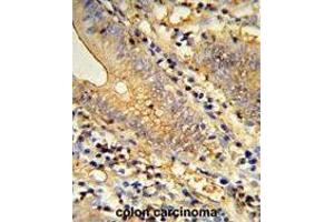 Formalin-fixed and paraffin-embedded human colon carcinoma reacted with TSPAN33 Antibody (C-term), which was peroxidase-conjugated to the secondary antibody, followed by DAB staining.