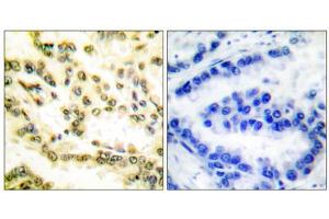 Immunohistochemical analysis of paraffin-embedded human lung carcinoma tissue, using Lamin A (cleaved-Asp230) antibody. (Lamin A/C anticorps  (Cleaved-Asp230, Internal Region))