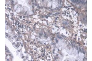 DAB staining on IHC-P; Samples: Human Liver cancer Tissue (PIIINP anticorps  (AA 24-153))