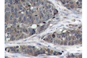 Immunohistochemistry analysis of NFκB-p105/p50 antibody in paraffin-embedded human breast carcinoma tissue. (NFKB1 anticorps)