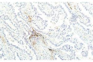 Immunohistochemistry of paraffin-embedded Human lung carcinoma tissue using JAK1 Monoclonal Antibody at dilution of 1:200. (JAK1 anticorps)