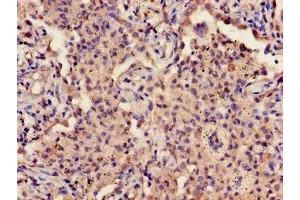Immunohistochemistry of paraffin-embedded human lung cancer using ABIN7163589 at dilution of 1:100