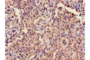 Immunohistochemistry of paraffin-embedded human lung cancer using ABIN7163589 at dilution of 1:100 (CD42a anticorps  (AA 17-88))