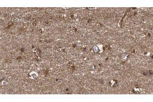 ABIN6279508 at 1/100 staining Human brain cancer tissue by IHC-P.