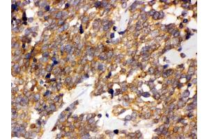 DDAH2 was detected in paraffin-embedded sections of human lung cancer tissues using rabbit anti- DDAH2 Antigen Affinity purified polyclonal antibody (Catalog # ) at 1 µg/mL.