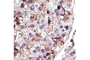 IHC analysis of FFPE human hepatocarcinoma tissue stained with the SPHK2 antibody (SPHK2 anticorps  (AA 1-30))