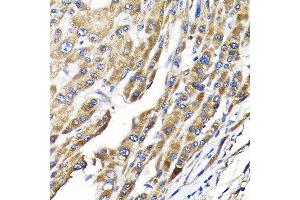 Immunohistochemistry of paraffin-embedded human liver cancer using IKBKAP Rabbit pAb (ABIN6130369, ABIN6142278, ABIN6142279 and ABIN6214265) at dilution of 1:100 (40x lens). (IKAP/p150 anticorps  (AA 1093-1332))