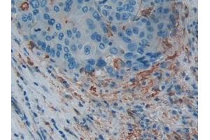 Detection of GSN in Human Liver cancer Tissue using Polyclonal Antibody to Gelsolin (GSN)