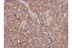 IHC-P Image Immunohistochemical analysis of paraffin-embedded Huh7 xenograft, using APOL1, antibody at 1:500 dilution.
