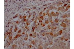 IHC image of  diluted at 1:100 and staining in paraffin-embedded human breast cancer performed on a Leica BondTM system. (Recombinant GSK3 beta anticorps)