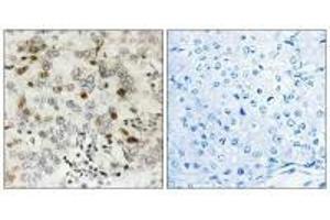 Immunohistochemistry analysis of paraffin-embedded human breast carcinoma tissue using CGREF1 antibody.