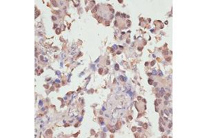 Immunohistochemistry of paraffin-embedded human lung cancer using Y antibody (ABIN6132789, ABIN6150317, ABIN6150322 and ABIN6215136) at dilution of 1:100 (40x lens). (YAP1 anticorps  (AA 155-504))
