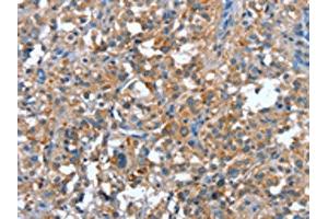 The image on the left is immunohistochemistry of paraffin-embedded Human thyroid cancer tissue using ABIN7191907(PLA2G6 Antibody) at dilution 1/15, on the right is treated with synthetic peptide. (PLA2G6 anticorps)