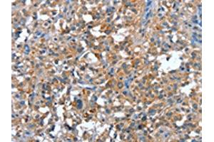 The image on the left is immunohistochemistry of paraffin-embedded Human thyroid cancer tissue using ABIN7191907(PLA2G6 Antibody) at dilution 1/15, on the right is treated with synthetic peptide. (PLA2G6 anticorps)