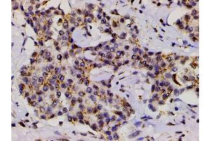 ABIN6267554 at 1/200 staining human liver cancer tissue sections by IHC-P.