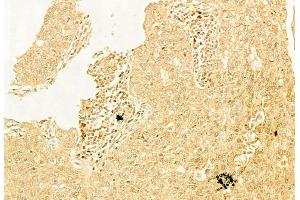 ABIN6262925 and ABIN6268948 at 1/100 staining Human lung cancer by IHC-P.
