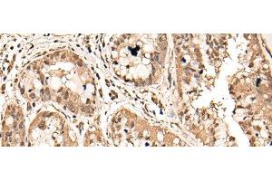 Immunohistochemistry of paraffin-embedded Human liver cancer tissue using ATAD3A Polyclonal Antibody at dilution of 1:40(x200) (ATAD3A anticorps)
