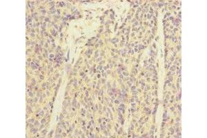 Immunohistochemistry of paraffin-embedded human ovarian cancer using ABIN7170910 at dilution of 1:100