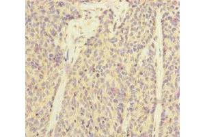 Immunohistochemistry of paraffin-embedded human ovarian cancer using ABIN7170910 at dilution of 1:100 (SUCLA2 anticorps  (AA 1-180))