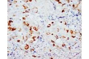 Immunohistochemical analysis of paraffin embedded Mammary cancer sections staining CD40L in cytoplasm, DAB chromogenic reaction