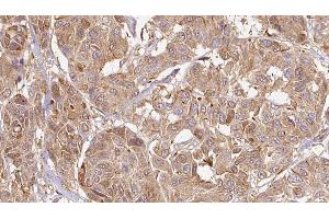 ABIN6276463 at 1/100 staining Human Melanoma tissue by IHC-P. (Endothelin 3 anticorps  (C-Term))