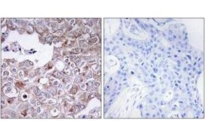 Immunohistochemistry analysis of paraffin-embedded human breast carcinoma tissue, using MUC1 Antibody. (MUC1 anticorps  (AA 1191-1240))