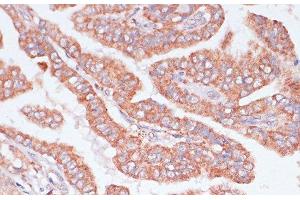 Immunohistochemistry of paraffin-embedded Human thyroid cancer using CDC20 Polyclonal Antibody at dilution of 1:100 (40x lens).