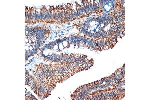 Immunohistochemistry of paraffin-embedded human colon carcinoma using LI Cadherin/Cadherin-17 Rabbit mAb (ABIN7268249) at dilution of 1:100 (40x lens).