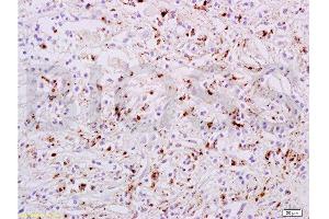 Formalin-fixed and paraffin embedded human liver carcinoma tissue labeled with Anti-phospho-STAT6(Tyr641) Polyclonal Antibody, Unconjugated  at 1:200 followed by conjugation to the secondary antibody, (SP-0023), and DAB staining