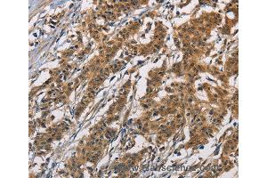 Immunohistochemistry of Human colon cancer using ATP2C1 Polyclonal Antibody at dilution of 1:60 (ATP2C1 anticorps)