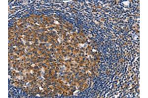 The image on the left is immunohistochemistry of paraffin-embedded Human tonsil tissue using ABIN7128916(CEP97 Antibody) at dilution 1/40, on the right is treated with fusion protein. (CEP97 anticorps)