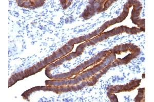 Formalin-fixed, paraffin-embedded human Ovarian Carcinoma stained with MUC-1 / CA15-3 / EMA Mouse Monoclonal Antibody (MUC1/520).