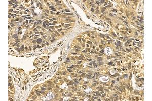 HSP70 Mouse Monoclonal Antibody at 1/100 staining human lung cancer and adjacent non-tumor tissue by IHC-P. (HSP70 anticorps  (C-Term))