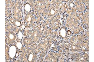 The image on the left is immunohistochemistry of paraffin-embedded Human thyroid cancer tissue using ABIN7128011(SERPINA7 Antibody) at dilution 1/25, on the right is treated with fusion protein. (SERPINA7 anticorps)