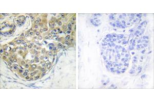 Immunohistochemistry analysis of paraffin-embedded human breast carcinoma tissue using ACK1 (Phospho-Tyr284) antibody.