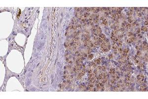 ABIN6273259 at 1/100 staining Human pancreas cancer tissue by IHC-P. (KIDINS220 anticorps  (Internal Region))