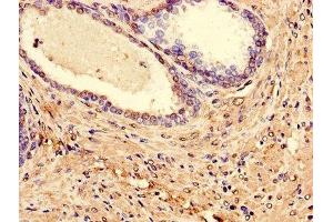 Immunohistochemistry of paraffin-embedded human prostate cancer using ABIN7158308 at dilution of 1:100 (Leupaxin anticorps  (AA 1-300))