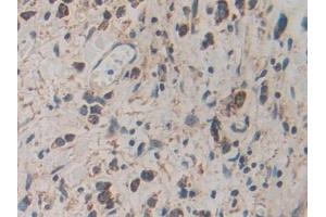 Detection of CACYBP in Human Stomach cancer Tissue using Polyclonal Antibody to Calcyclin Binding Protein (CACYBP)