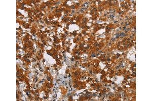 Immunohistochemistry of Human thyroid cancer using SMAD9 Polyclonal Antibody at dilution of 1:40 (SMAD9 anticorps)