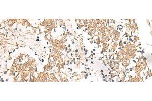 Immunohistochemistry of paraffin-embedded Human lung cancer tissue using HNF1A Polyclonal Antibody at dilution of 1:25(x200) (HNF1A anticorps)