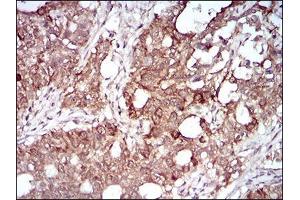 Immunohistochemical analysis of paraffin-embedded cervical cancer tissues using MMEL1 mouse mAb with DAB staining. (MMEL1 anticorps  (AA 1-107))