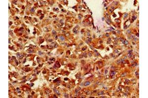 Immunohistochemistry of paraffin-embedded human melanoma using ABIN7146559 at dilution of 1:100