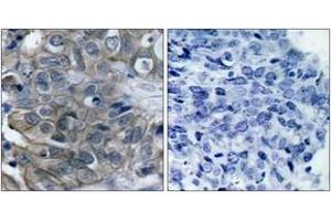 Immunohistochemistry analysis of paraffin-embedded human breast carcinoma tissue, using HER2 (Ab-877) Antibody. (ErbB2/Her2 anticorps  (AA 851-900))