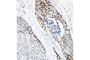 Anti-p63 antibody, IHC(P) IHC(P): Human Esophageal Squamous Cell Carcinoma Tissue
