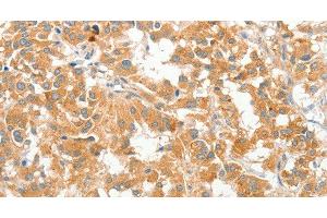 Immunohistochemistry of paraffin-embedded Human thyroid cancer using COL4A3BP Polyclonal Antibody at dilution of 1:60 (COL4A3BP anticorps)