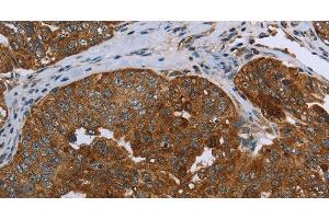 Immunohistochemistry of paraffin-embedded Human ovarian cancer using SNCG Polyclonal Antibody at dilution of 1:60 (SNCG anticorps)